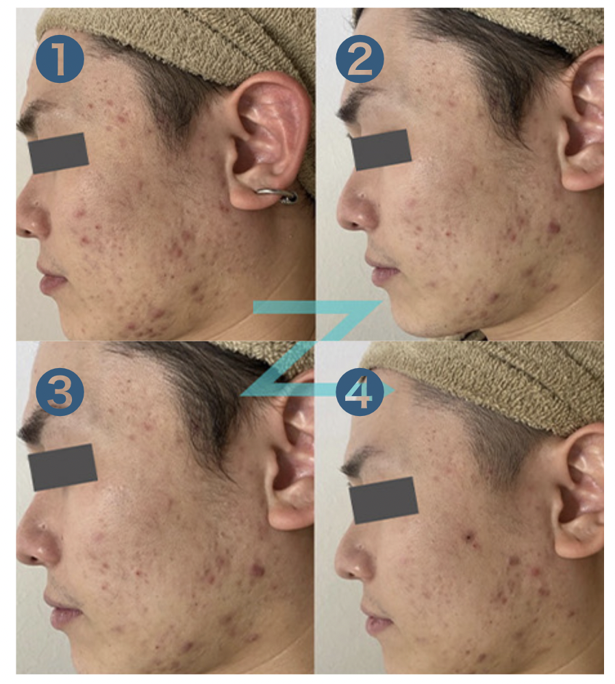 シミプラズマ（plasma-Neo） Dr.Viseaのプラズマ美顔器『シミプラズマ