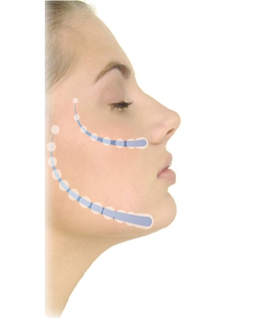 最新型アイススカルプティングガン 導入ガン 美容サロン専用 高浸透