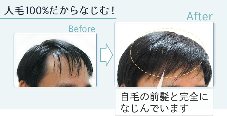 増毛くん｜生え際、M字、そりこみ、つむじをセルフ増毛。円形脱毛も