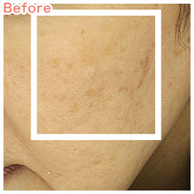 エレクトロポレーション | 自由が丘ロジエクリニック