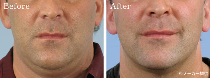 サーマクール フラクショナル 冷却 高周波 サーマクールFLX/CPT｜医療