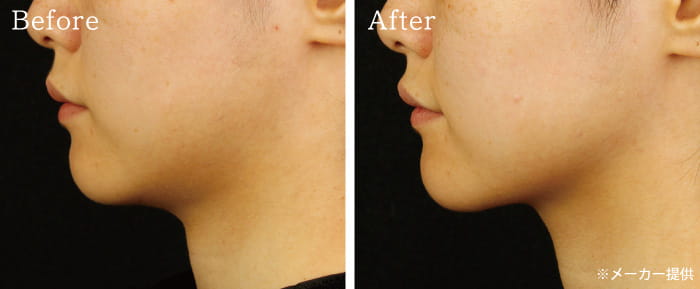 サーマクール フラクショナル 冷却 高周波 サーマクールFLX/CPT｜医療