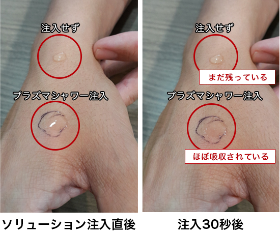 プラズマシャワー - ル クリニック｜恵比寿駅徒歩2分の美容外科・美容